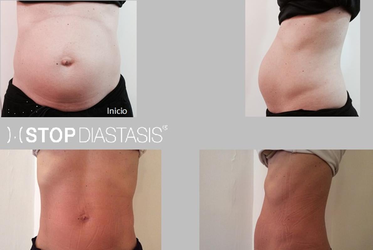 Tipos de abdominales durante el embarazo